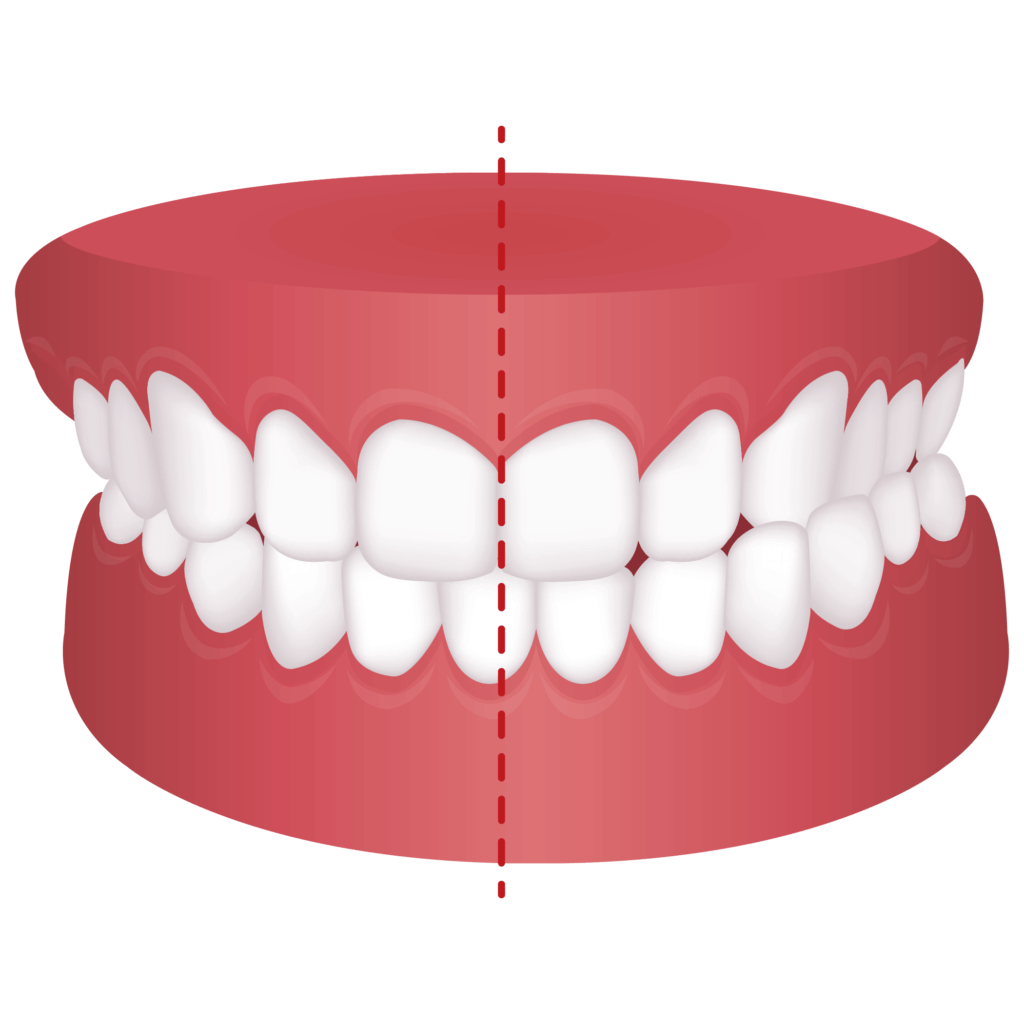 image of Crossbite