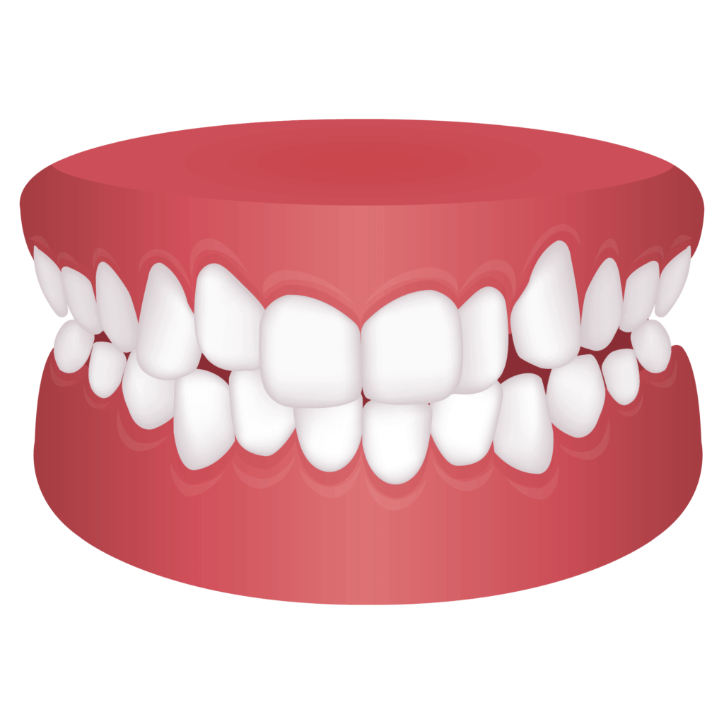 image of Teeth crowding