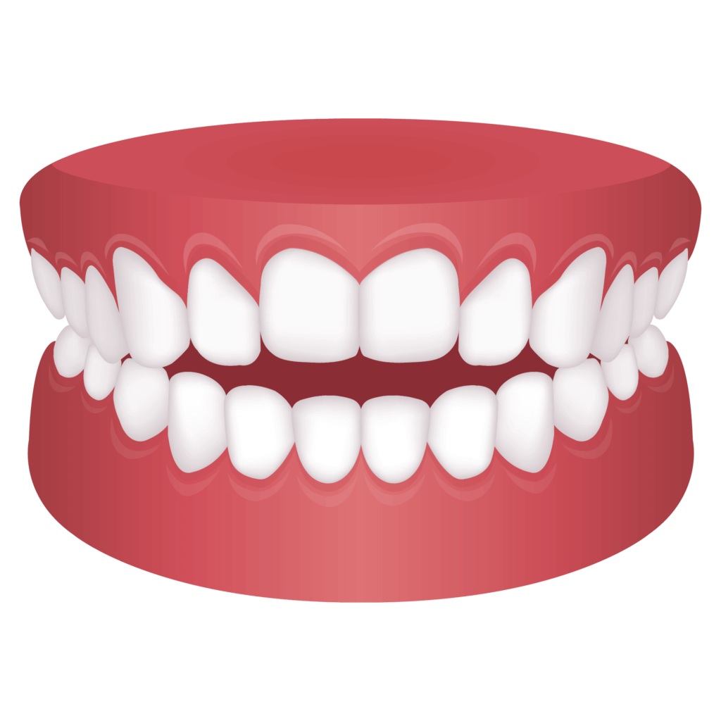 image of Openbite