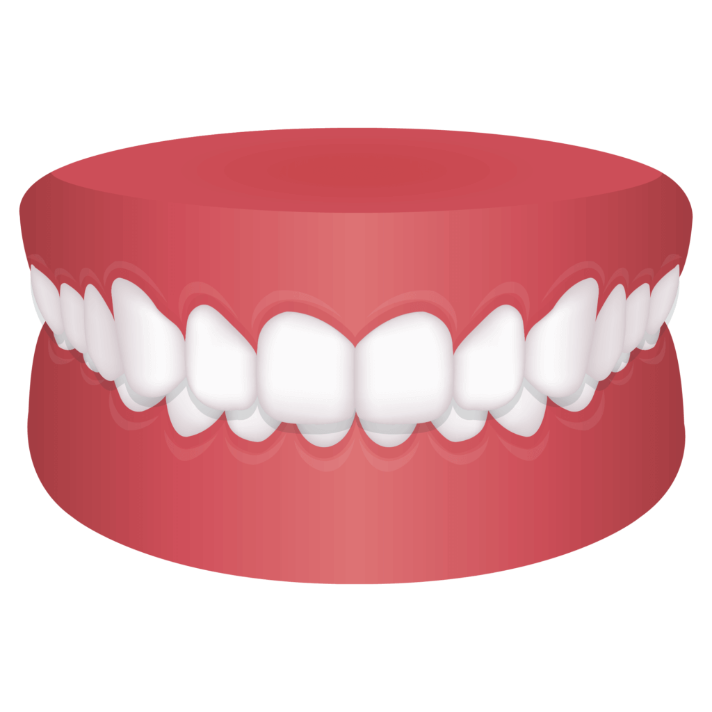 image of Overbite