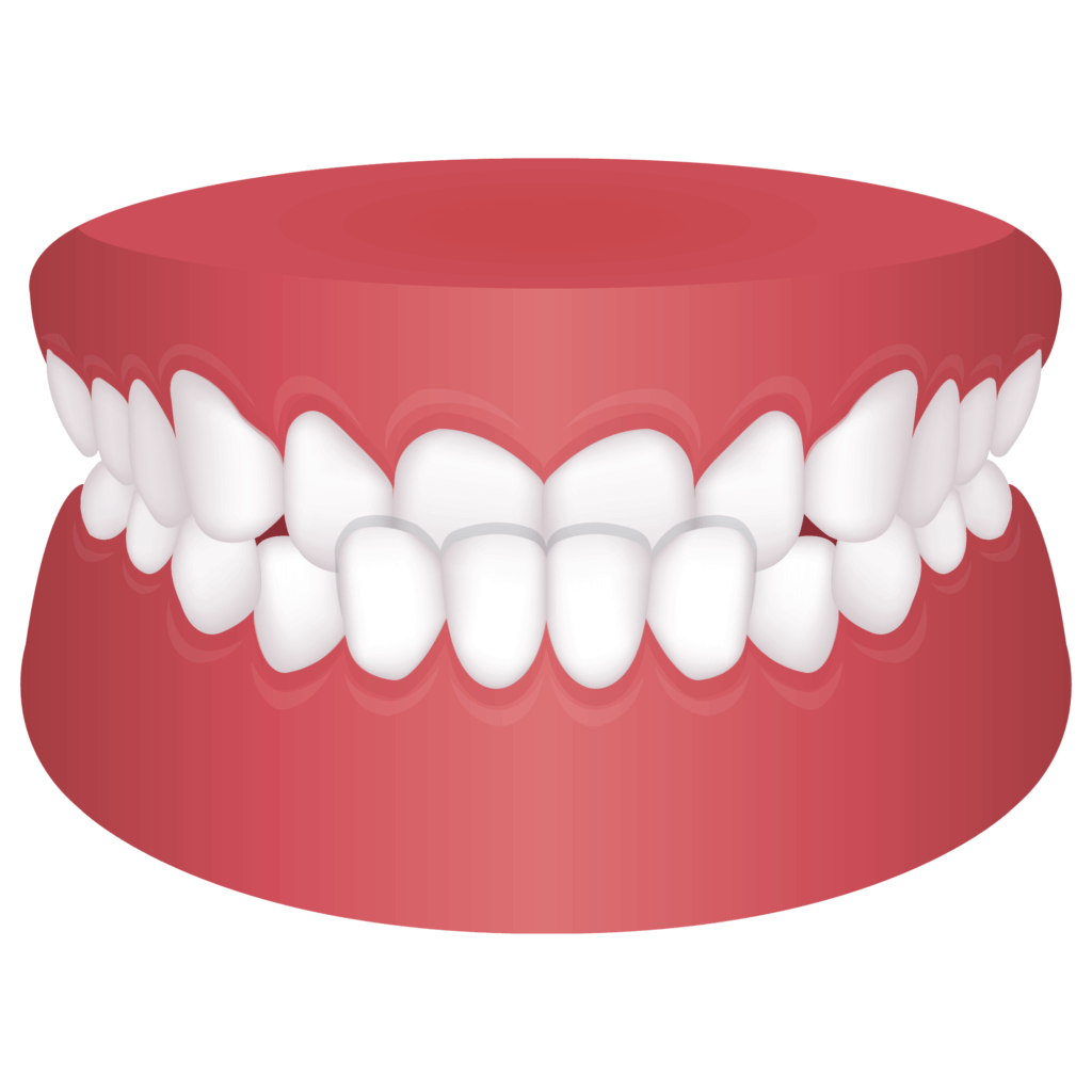 image of Underbite